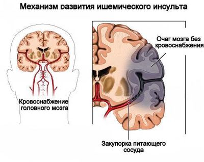 Ишемический инсульт