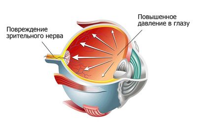 Диагностика в офтальмологии: измерение внутриглазного давления
