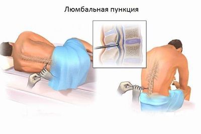 люмбальная пункция
