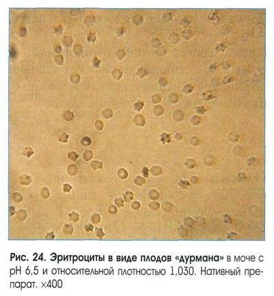 эритроциты в моче