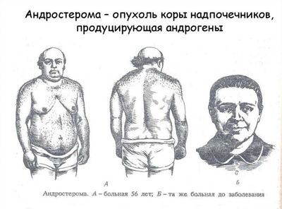 Андростерома