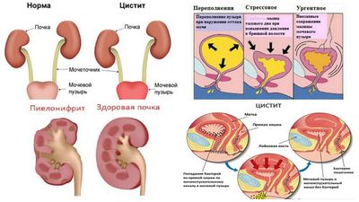 пиелонефрит