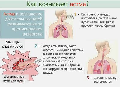 Как возникает астма