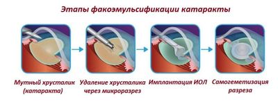 Этапы факоэмульсификации катаракты