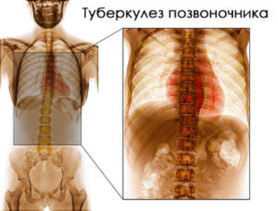 Туберкулез костей