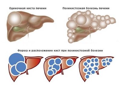 Множественные кисты в печени