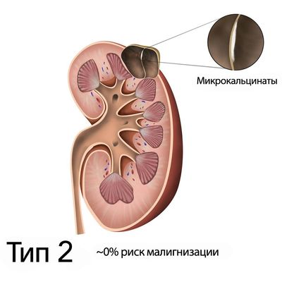 босниак тип 2