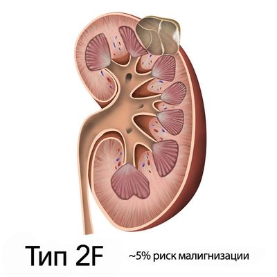 босниак тип 2F