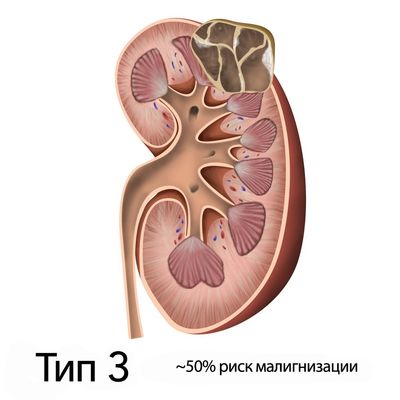босниак тип 3
