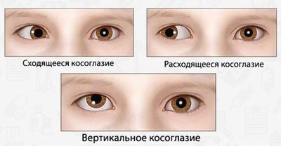 Разновидности косоглазия