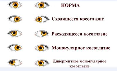 Классификация косоглазия