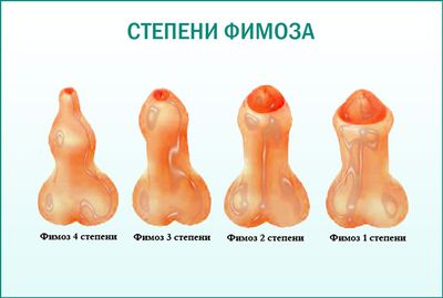 Мази при лечении фимоза