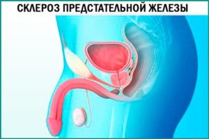 Склероз простаты