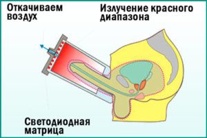 Электростимуляция предстательной железы