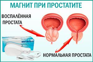 Лечение простатита магнитом
