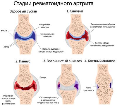 Развитие артрита