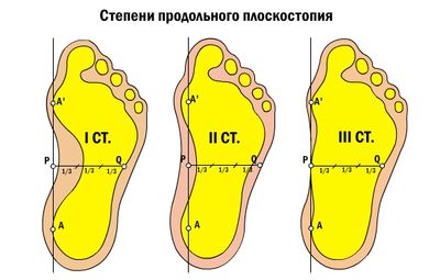 Степени плоскостопия