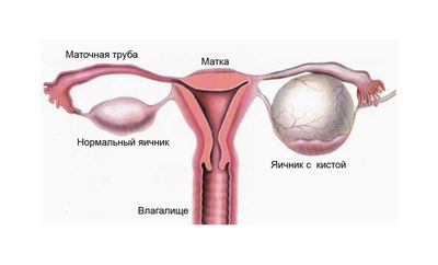 Киста яичника - показание к использованию мази