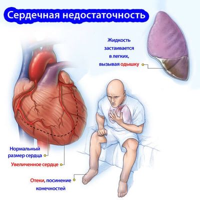 сердечная недостаточность схема-2