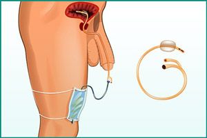 Катетеризация мешком-мочеприемником