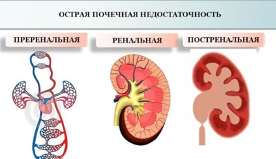 почечная недостаточность