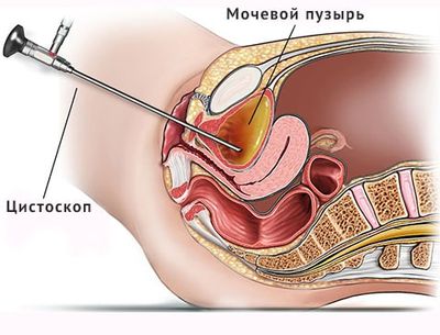 цистоскопия