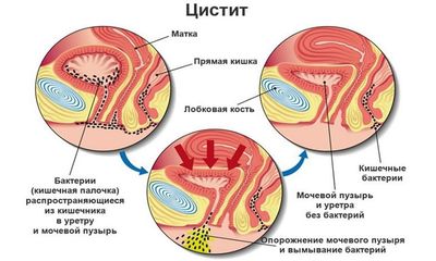 пути попадания инфекций в мочевой пузырь
