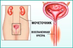 Уретрит у женщин
