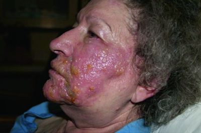 herpes zoster