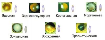 Типы катаракты