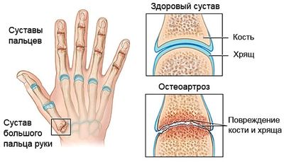 Остеоартроз рук