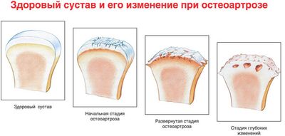 Три стадии остеоартроза