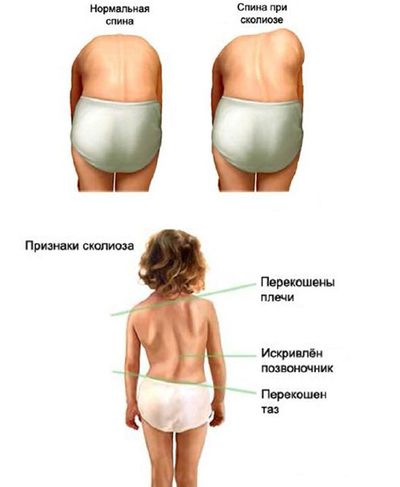 признаки сколиоза