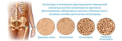 Остеопороз у женщин после 50 лет