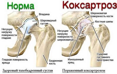 Коксартроз