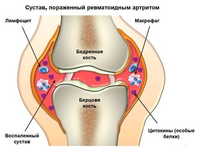 ревматизм