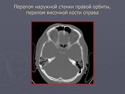 Диагностика перелома