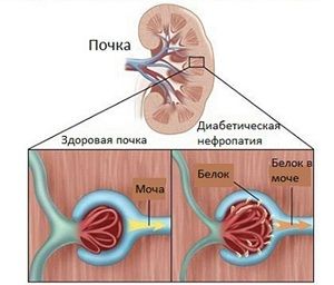 Диабетическая нефропатия