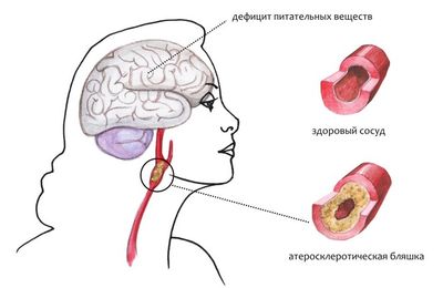 Энцефалопатия