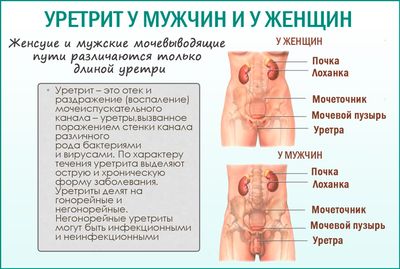 Медикаментозные средства для лечения воспаления уретры