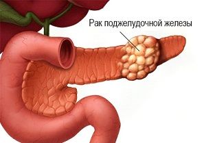Прогнозы срока жизни при раке поджелудочной железы