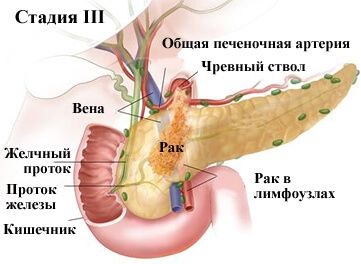 3 стадия рака