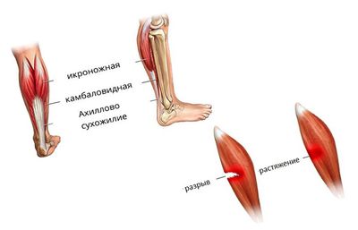 Растяжение мышц ноги — чем грозит не лечение болезни