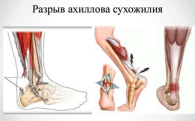Разрыв ахиллова сухожилия