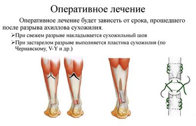 Оперативное лечение при разрыве ахилла