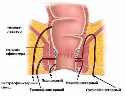 Свищи прямой кишки