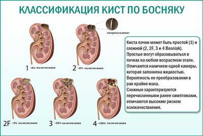 Кисты в почках