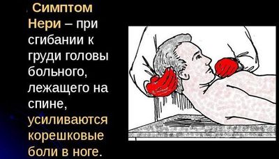 Симптом Нери