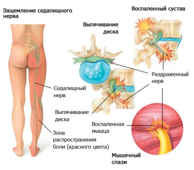 Болезни позвоночника – основная причина развития ишиаса