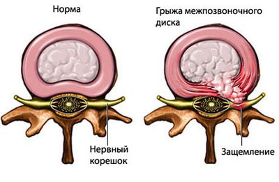 Операцию проводят при межпозвоночной грыже
